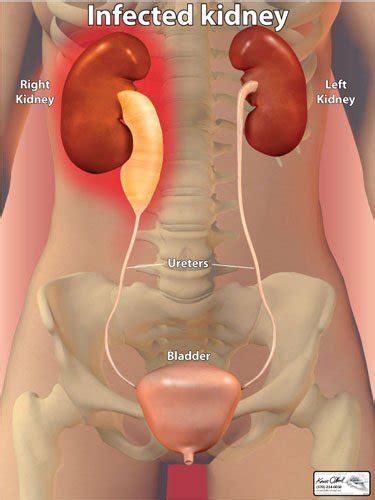 Kidney Infection Signs And Symptom And Risks