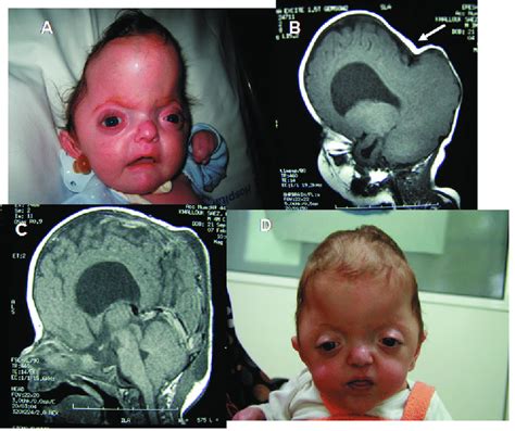 Cloverleaf Skull In A 5 Month Toddler Apert Syndrome A