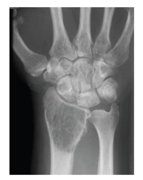 Preoperative Radiographs Demonstrating A Giant Cell Tumour Of The