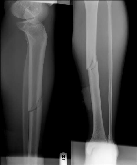 Orthopedics How To Tell If My Leg Fracture Is Healing Medical