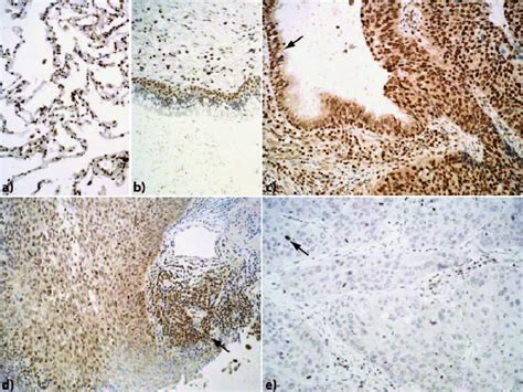 We did not find results for: Immunostaining of normal lung parenchyma and lung cancer ...