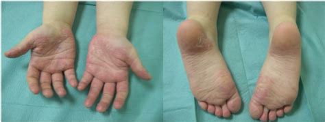 Hand Foot Syndrome In A Child Treated With Ara C For Al Download