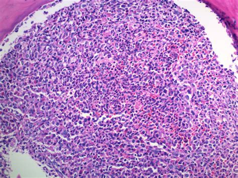 Pathology Outlines Chronic Myeloid Leukemia Cml Bcrabl1 Positive