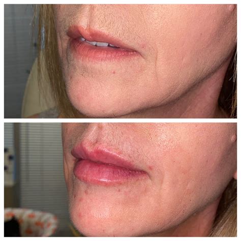 Dermal Filler Before And After Onyx Integrative Medicine And Aesthetics