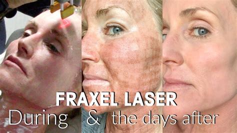 My FRACTIONAL CO LASER Experience The FULL Treatment The DAYS Following BEFORE AFTER