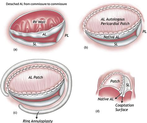 Figure 2 From Tricuspid Leaflet Augmentation To Address Severe