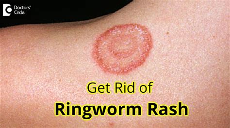 How To Get Rid Of Ringworm Permanently