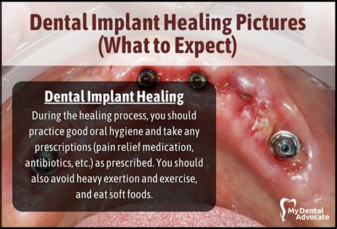 Dental Implant Healing Pictures What To Expect Mda