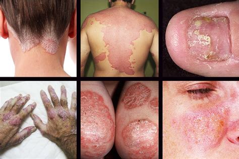 Take bath after 2 hours. Natural Ways to Treat Psoriasis in Ayurveda