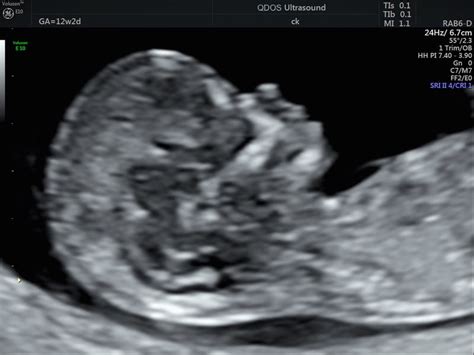 Ultrasound Baby 12 Week Pregnancy Babypregnancy