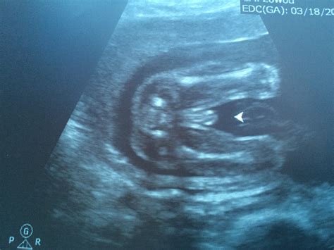 How Accurate Is The Gender Reveal At 20 Weeks March 2015 Babies