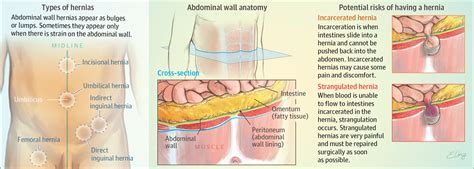 Pain can arise from the colon, urinary system, reproductive organs, vascular system and or stomach wall muscles. What Is an Abdominal Wall Hernia? | Surgery | JAMA | JAMA Network