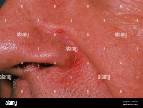 Seborrhoeic Dermatitis Close Up Of The Nose Of A Patient Affected By