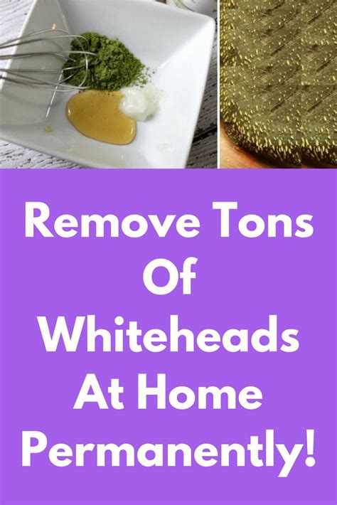 Remove Tons Of Whiteheads At Home Permanently 100 Guaranteed Result