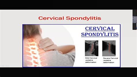 Homoeopathic Management Of Cervical Spondylosis YouTube