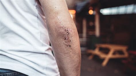 Bumps On Elbow Causes Symptoms And Treatments