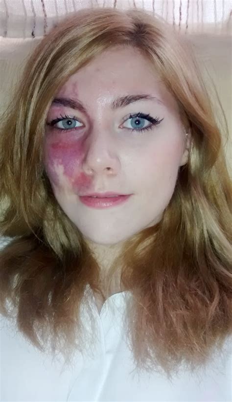 Woman With Birthmark Told She Is Undateable Popsugar Beauty Photo 3