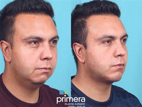 Buccal Fat Cheek Fat Removal And Chin Implant In Orlando Florida