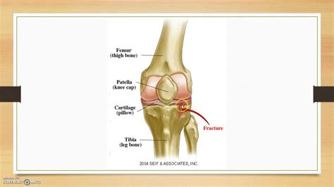 Arthroscopic reduction and internal fixation. Tibial Avulsion Fracture - YouTube