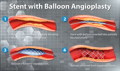 Free Vector Diagram Showing Stent With Balloon Angioplasty In Human