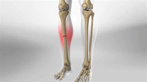 Tibia Fracture Types Symptoms And Treatment Orthopedic Treatment