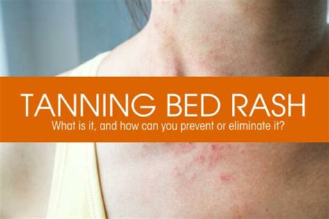 Tanning Bed Rash What Is It And How Can You Prevent Or Eliminate It