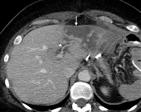 Liver Atlas Case 82 Hepatic Infarct Subsegmental Well Defined Left