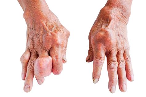 Dna moczanowa artretyzm podagra jakie są przyczyny objawy i metody leczenia Zouza pl