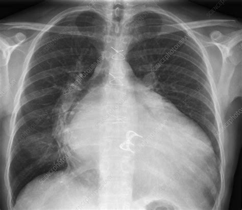 Prosthetic Heart Valve X Ray Stock Image M5600594 Science Photo