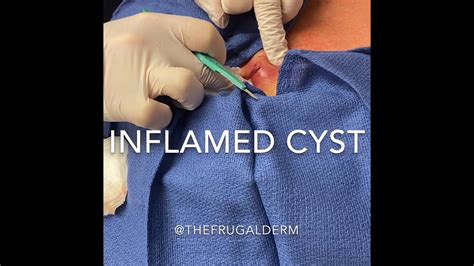 Inflamed Cyst Incision And Drainage Youtube