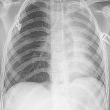 Chest X Ray Showing Malpositioned Intercostal Drainage Tube In A Case