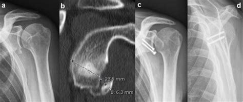 Case Example Of A Large Glenoid Rim Fracture And Screw Fixation