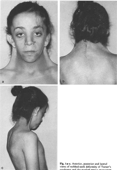 Figure From Correction Of Webbed Neck Deformity In Turner S Syndrome