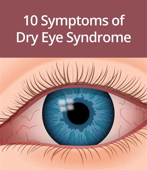 12 Ways To Relieve Dry Eye Syndrome Dry Eyes Dry Eye Syndrome Dry