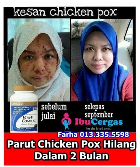 Prior to this vaccine's creation, it was a common practice for. Pin on Ubat Hilangkan Parut Chicken Pox
