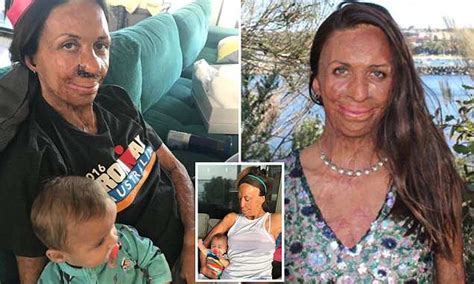 Turia Pitt Undergoes A Nose Reconstruction Daily Mail Online