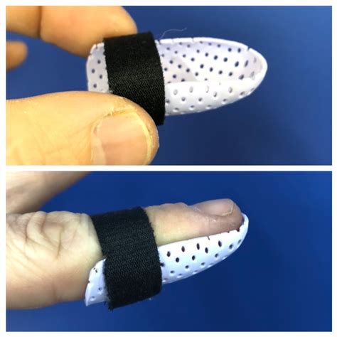 Five Common Mallet Finger Splints 2022