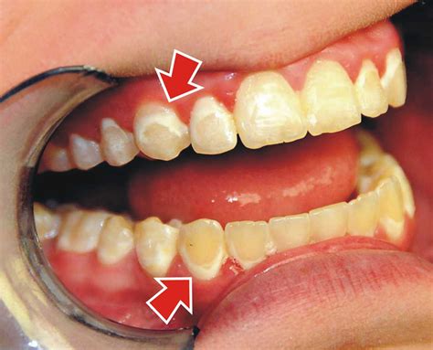 How To Get White Spots Off Of Teeth What Happen World