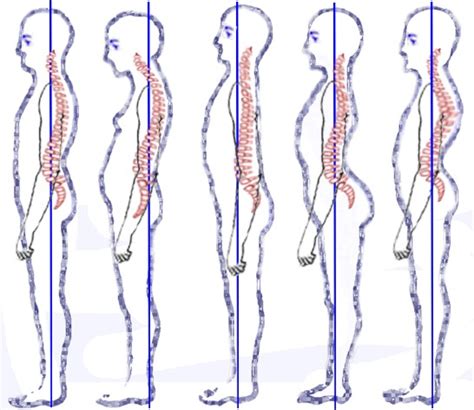 Sway Back Posture Physiopedia