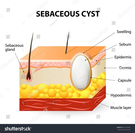 Sebaceous Cysts Trichilemmal Cyst Schematic Illustration Stock Vector