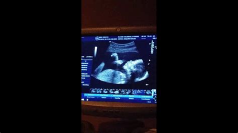 Unborn Baby Waving To Me And Sucking Thumb At 20 Weeks