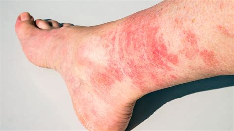 Lib Ral Effondrer Calomnie Leg Rash Causes Initialement Microscopique