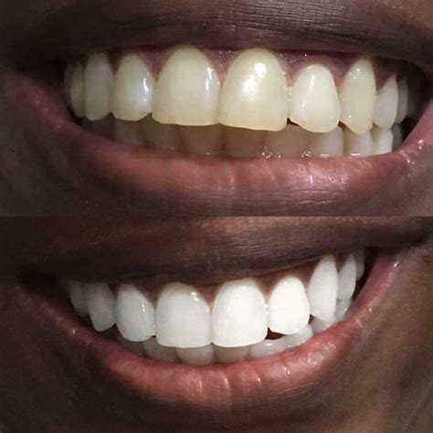 Pin On Tooth Whitening Toothpaste