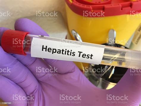 Test Tube For Viral Hepatitis Blood Test Stock Photo Download Image