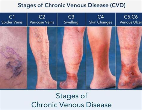 Stages Of Chronic Venous Disease Medizzy