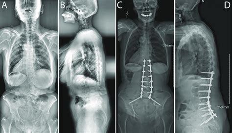 Preoperative Anteroposterior A And Lateral B Radiographs And
