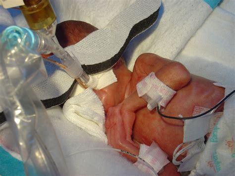 Micro Preemie Twins The Story Of H E Weeks And Days
