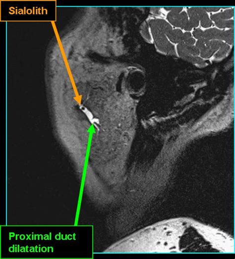 Sialolithiasis Radiology Iowa Head And Neck Protocols