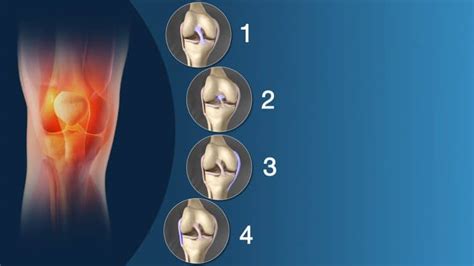 How To Treat A Sprained Knee Physioroom Blog