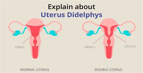 Uterus Didelphys Understanding The Double Uterus Condition Birla